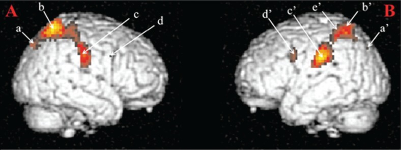 Sexual addiction: insights from psychoanalysis and functional neuroimaging.