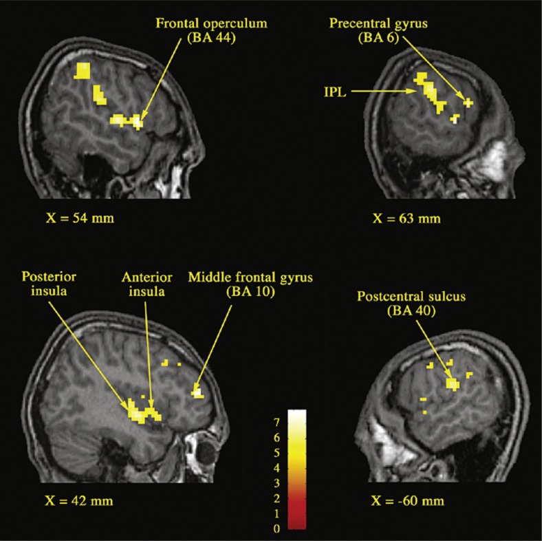 Sexual addiction: insights from psychoanalysis and functional neuroimaging.