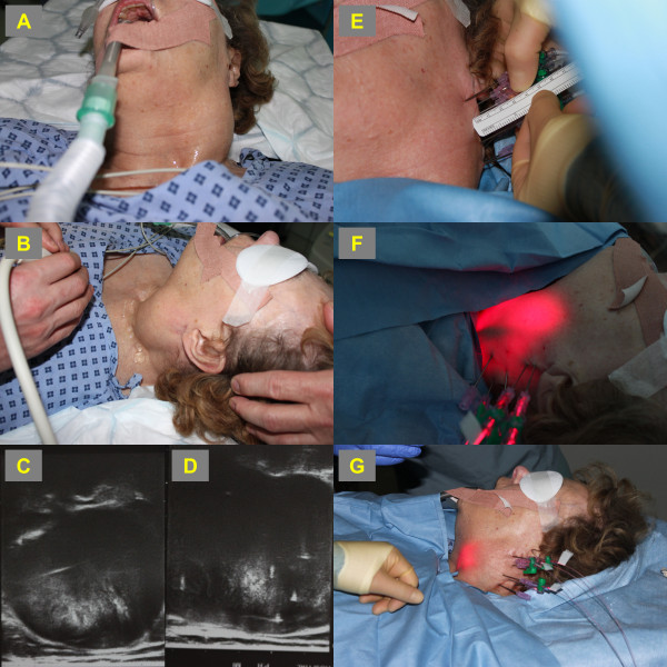 Solitary giant neurofibroma of the neck subjected to photodynamic therapy: case study.