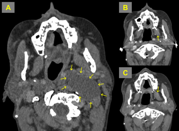 Solitary giant neurofibroma of the neck subjected to photodynamic therapy: case study.