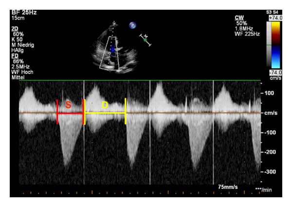 Transthoracic echocardiography in children and young adults with congenital heart disease.