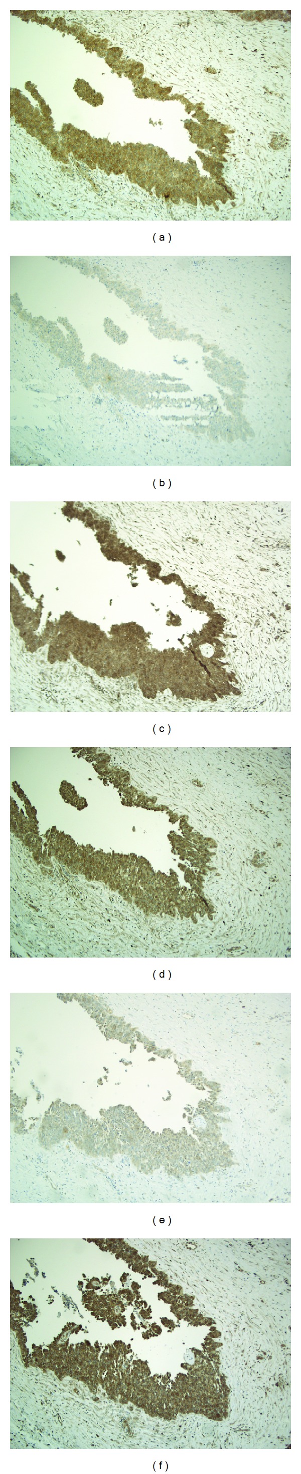 Immunohistochemical expression of platelet-derived growth factor receptors in ovarian cancer patients with long-term follow-up.