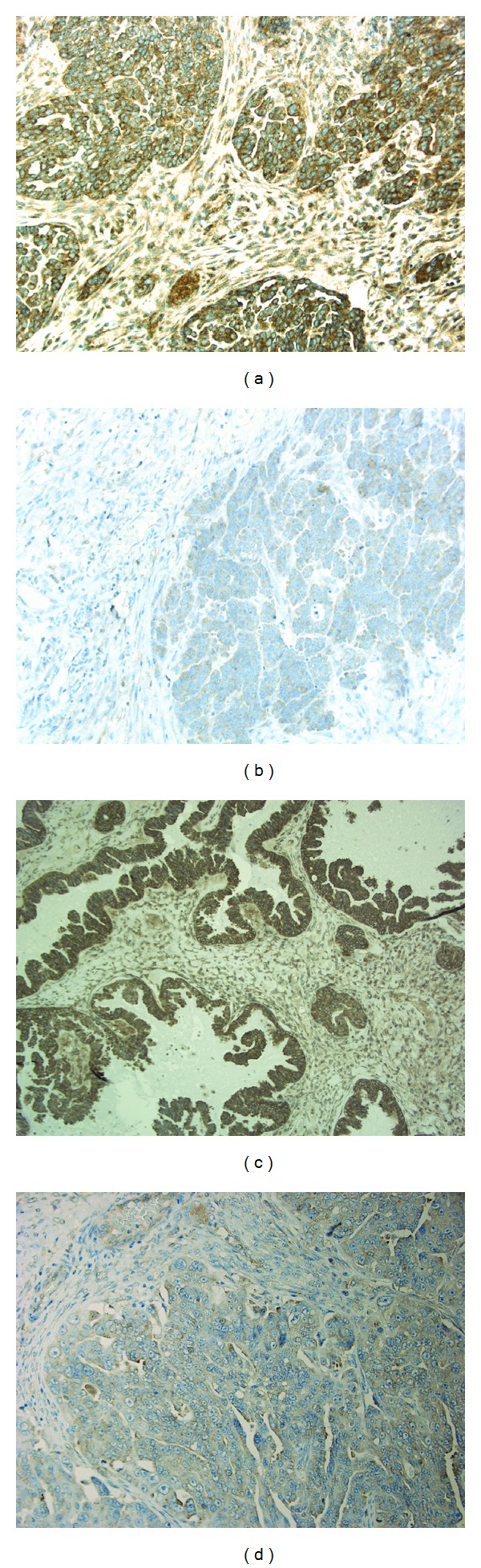 Immunohistochemical expression of platelet-derived growth factor receptors in ovarian cancer patients with long-term follow-up.