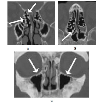 Irrigation nose: CT findings of paranasal sinus exostoses.