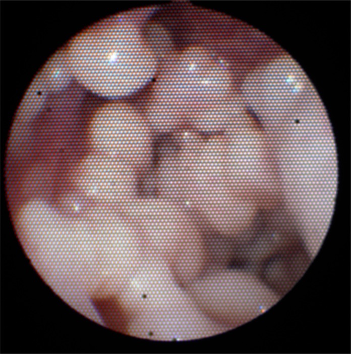 Irrigation nose: CT findings of paranasal sinus exostoses.