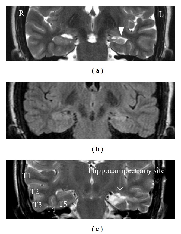 Surgical techniques for the treatment of temporal lobe epilepsy.