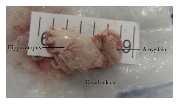 Surgical techniques for the treatment of temporal lobe epilepsy.