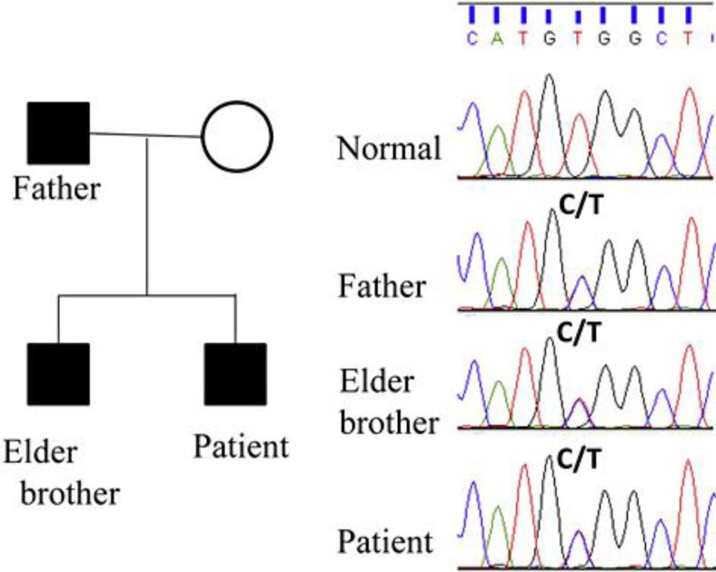 A Japanese Family Suffering from Familial Juvenile Hyperuricemic Nephropathy due to a Rare Mutation of the Uromodulin Gene.