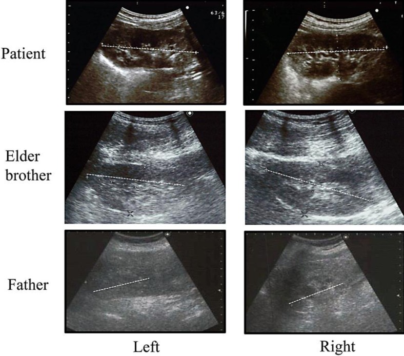 A Japanese Family Suffering from Familial Juvenile Hyperuricemic Nephropathy due to a Rare Mutation of the Uromodulin Gene.