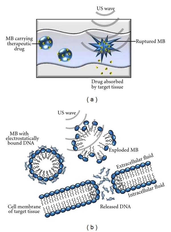 PLGA Nanoparticles for Ultrasound-Mediated Gene Delivery to Solid Tumors.