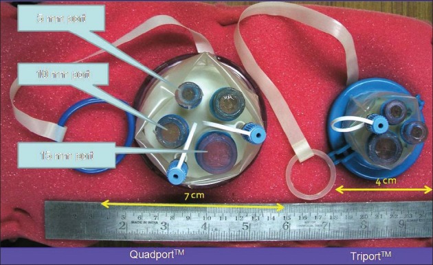 Laparoendoscopic single-site donor nephrectomy.