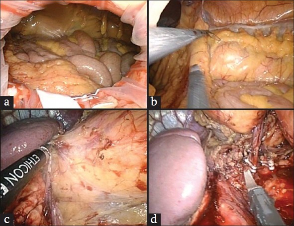 Laparoendoscopic single-site donor nephrectomy.