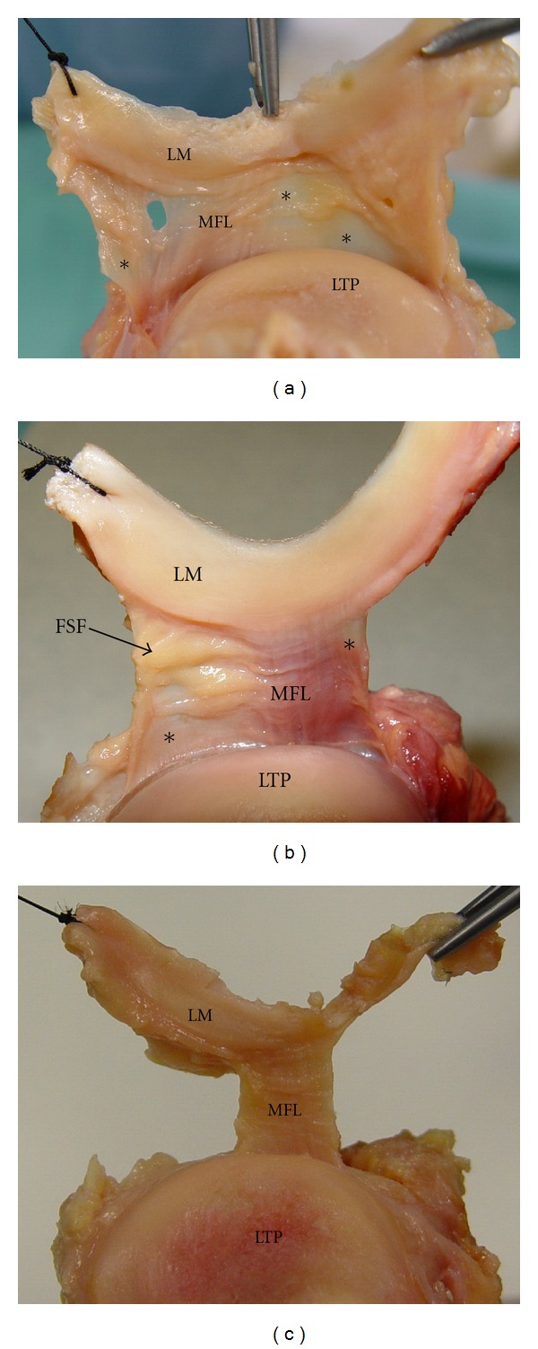 Meniscofibular ligament: morphology and functional significance of a relatively unknown anatomical structure.