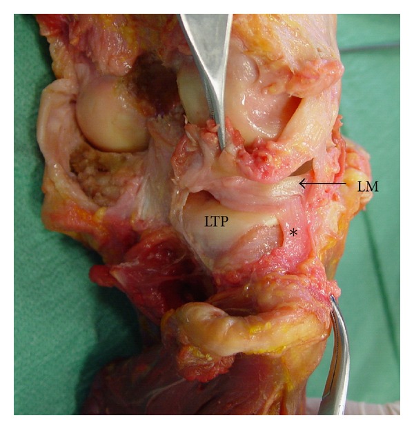 Meniscofibular ligament: morphology and functional significance of a relatively unknown anatomical structure.