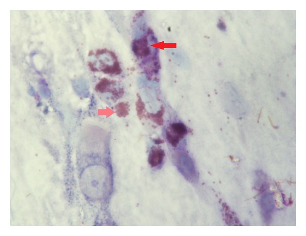 Cytological aspects on the effects of a nasal spray consisting of standardized extract of citrus lemon and essential oils in allergic rhinopathy.