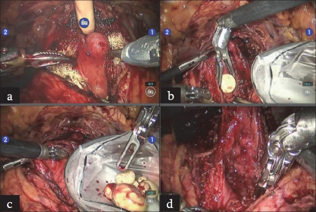 Cystolithotomy during robotic radical prostatectomy: Single-stage procedure for concomitant bladder stones.