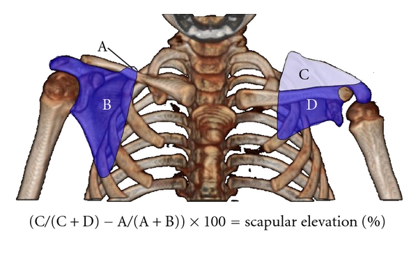 Risk factors at birth for permanent obstetric brachial plexus injury and associated osseous deformities.