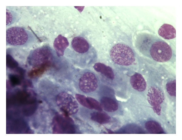 Cytological aspects on the effects of a nasal spray consisting of standardized extract of citrus lemon and essential oils in allergic rhinopathy.