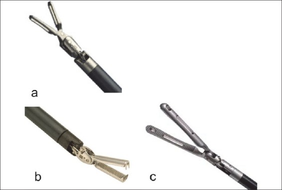 Cystolithotomy during robotic radical prostatectomy: Single-stage procedure for concomitant bladder stones.
