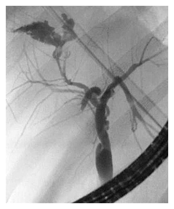 Bile duct leaks from the intrahepatic biliary tree: a review of its etiology, incidence, and management.