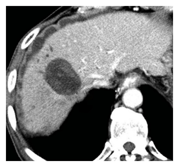 Bile duct leaks from the intrahepatic biliary tree: a review of its etiology, incidence, and management.