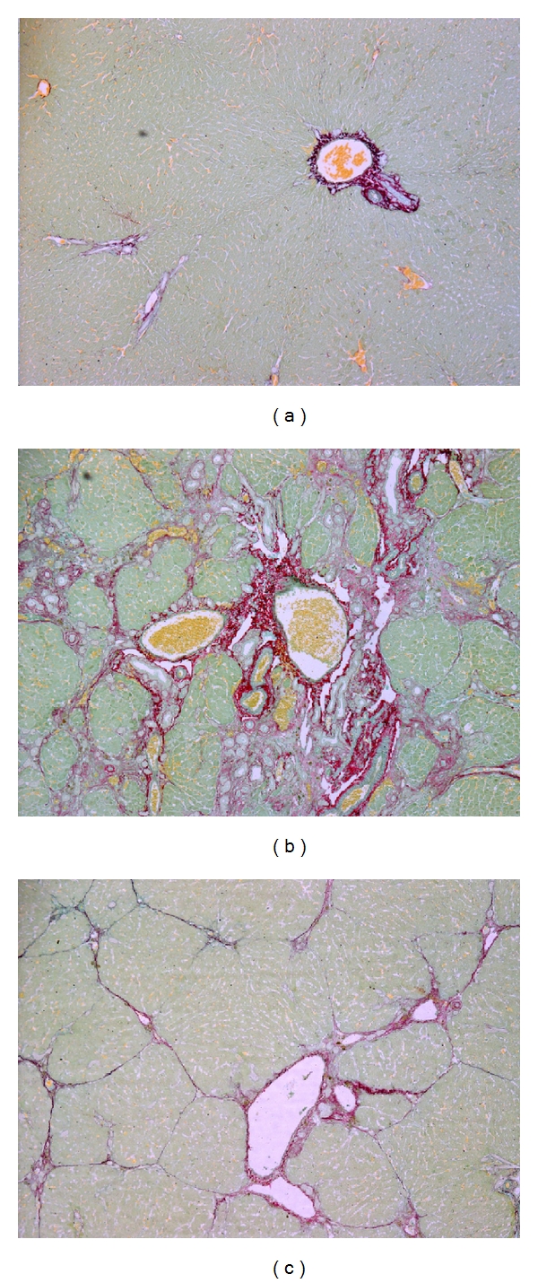 Effect of antioxidant treatment on fibrogenesis in rats with carbon tetrachloride-induced cirrhosis.