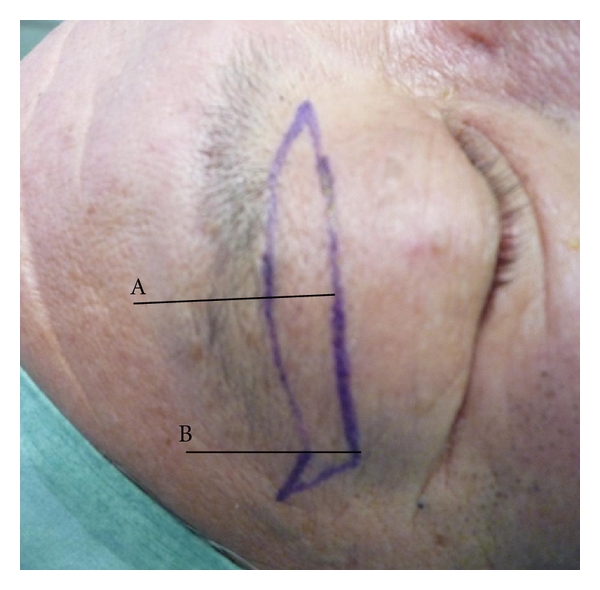 Infraeyebrow blepharoplasty for blepharochalasis of the upper eyelid: its indication and priority.