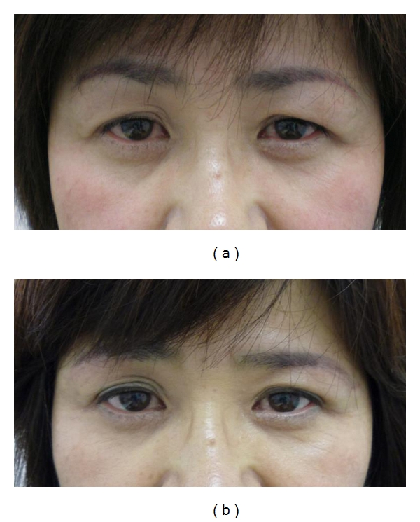 Infraeyebrow blepharoplasty for blepharochalasis of the upper eyelid: its indication and priority.