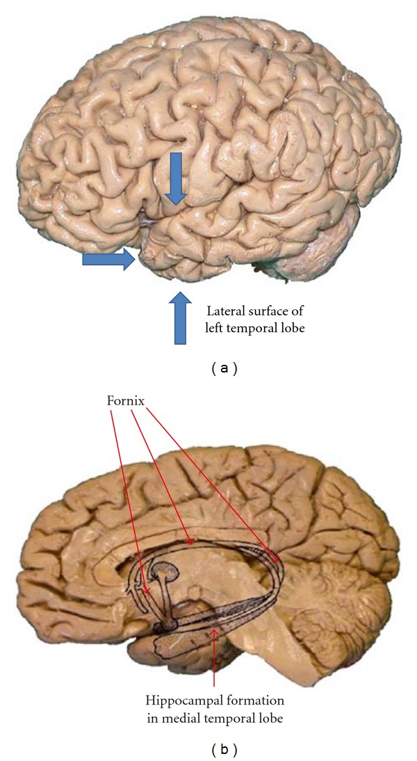 Role of functional MRI in presurgical evaluation of memory function in temporal lobe epilepsy.