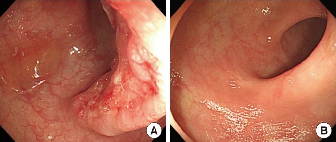 A case of sigmoid colon tuberculosis mimicking colon cancer.