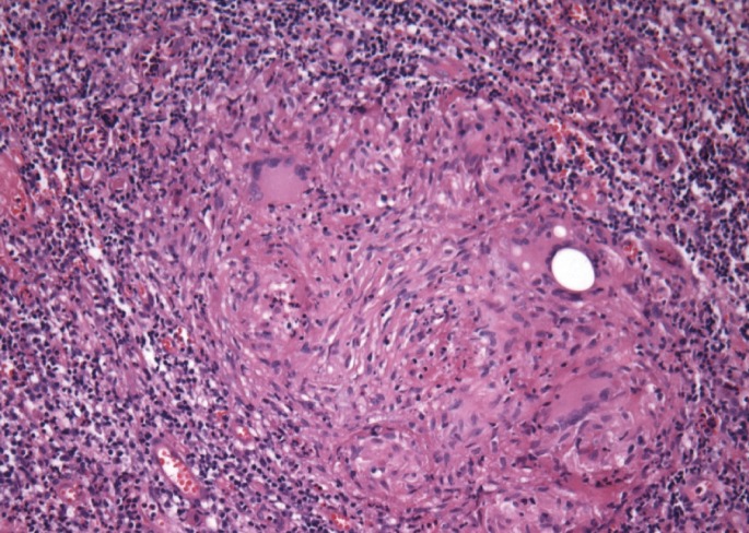 A case of sigmoid colon tuberculosis mimicking colon cancer.