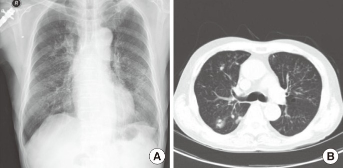 A case of sigmoid colon tuberculosis mimicking colon cancer.