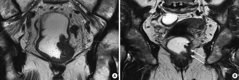 Update and debate issues in surgical treatment of middle and low rectal cancer.