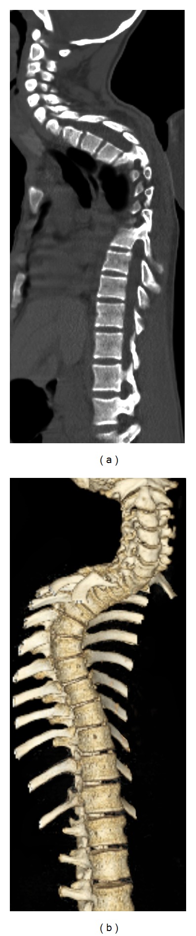 Three-Dimensional Volume-Rendered Series Complements 2D Orthogonal Multidetector Computed Tomography in the Evaluation of Abnormal Spinal Curvature in Patients at a Major Cancer Center: A Retrospective Review.