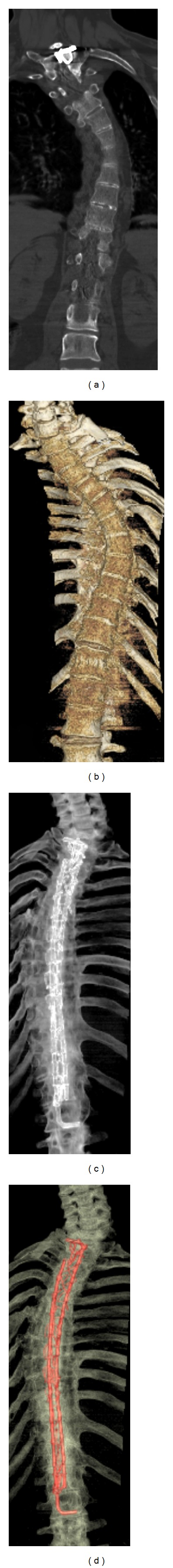 Three-Dimensional Volume-Rendered Series Complements 2D Orthogonal Multidetector Computed Tomography in the Evaluation of Abnormal Spinal Curvature in Patients at a Major Cancer Center: A Retrospective Review.