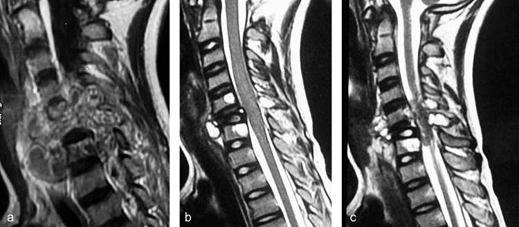 Surgical management of giant multilevel aneurysmal bone cyst of cervical spine in a 10-year-old boy: case report with review of literature.