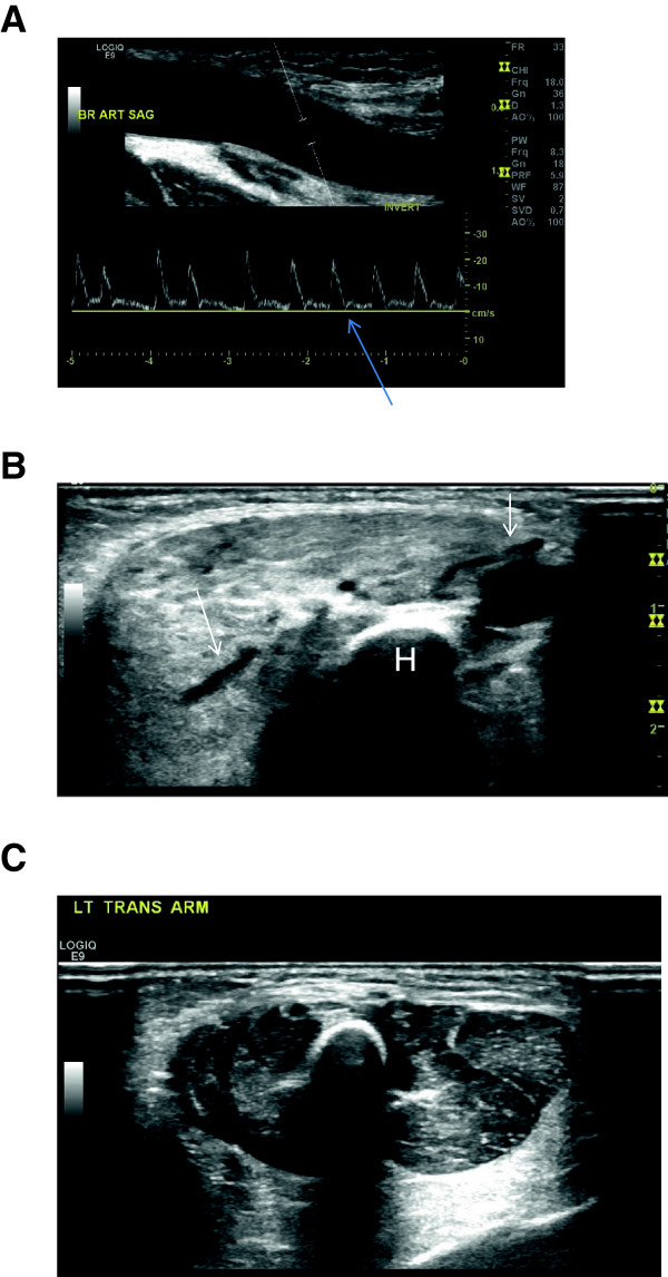 CM-AVM syndrome in a neonate: case report and treatment with a novel flow reduction strategy.