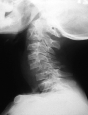 Surgical management of giant multilevel aneurysmal bone cyst of cervical spine in a 10-year-old boy: case report with review of literature.