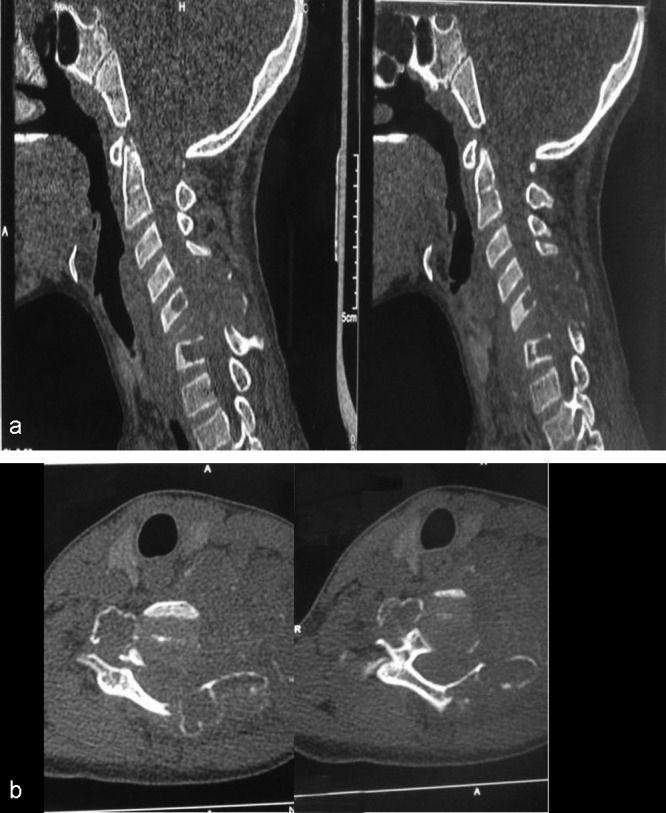 Surgical management of giant multilevel aneurysmal bone cyst of cervical spine in a 10-year-old boy: case report with review of literature.