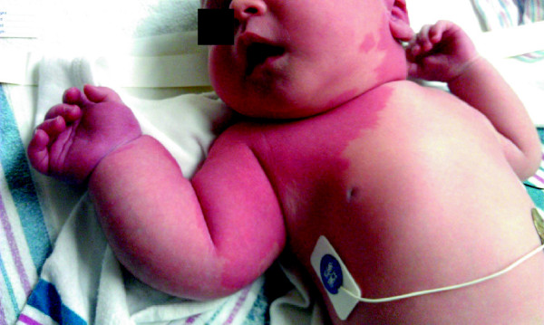 CM-AVM syndrome in a neonate: case report and treatment with a novel flow reduction strategy.