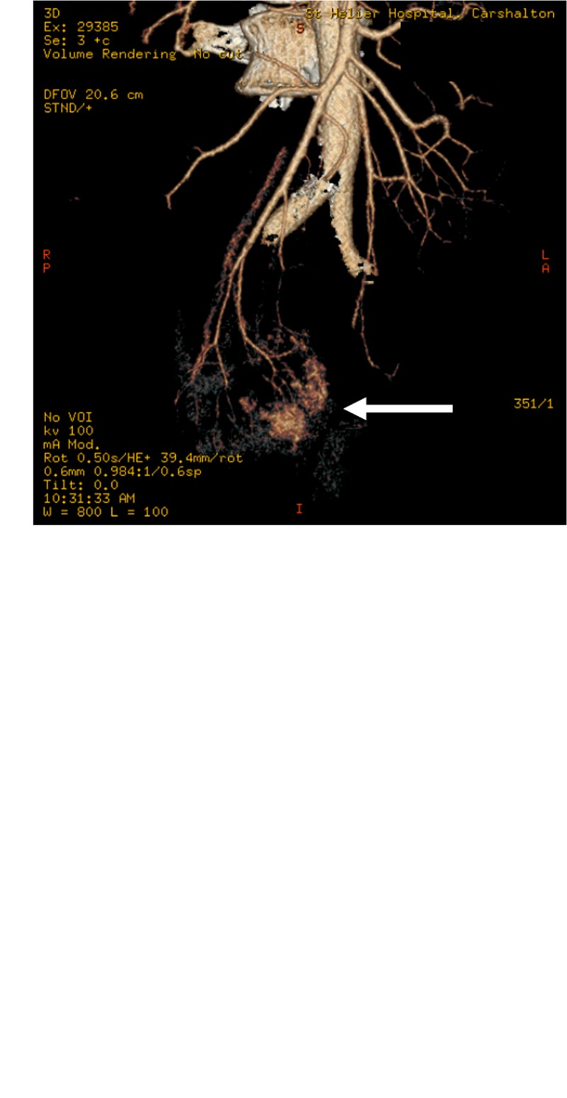 A rare cause of small bowel bleeding.