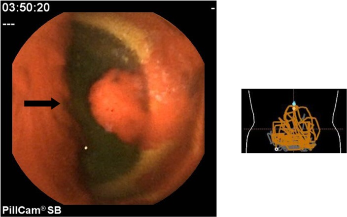 A rare cause of small bowel bleeding.