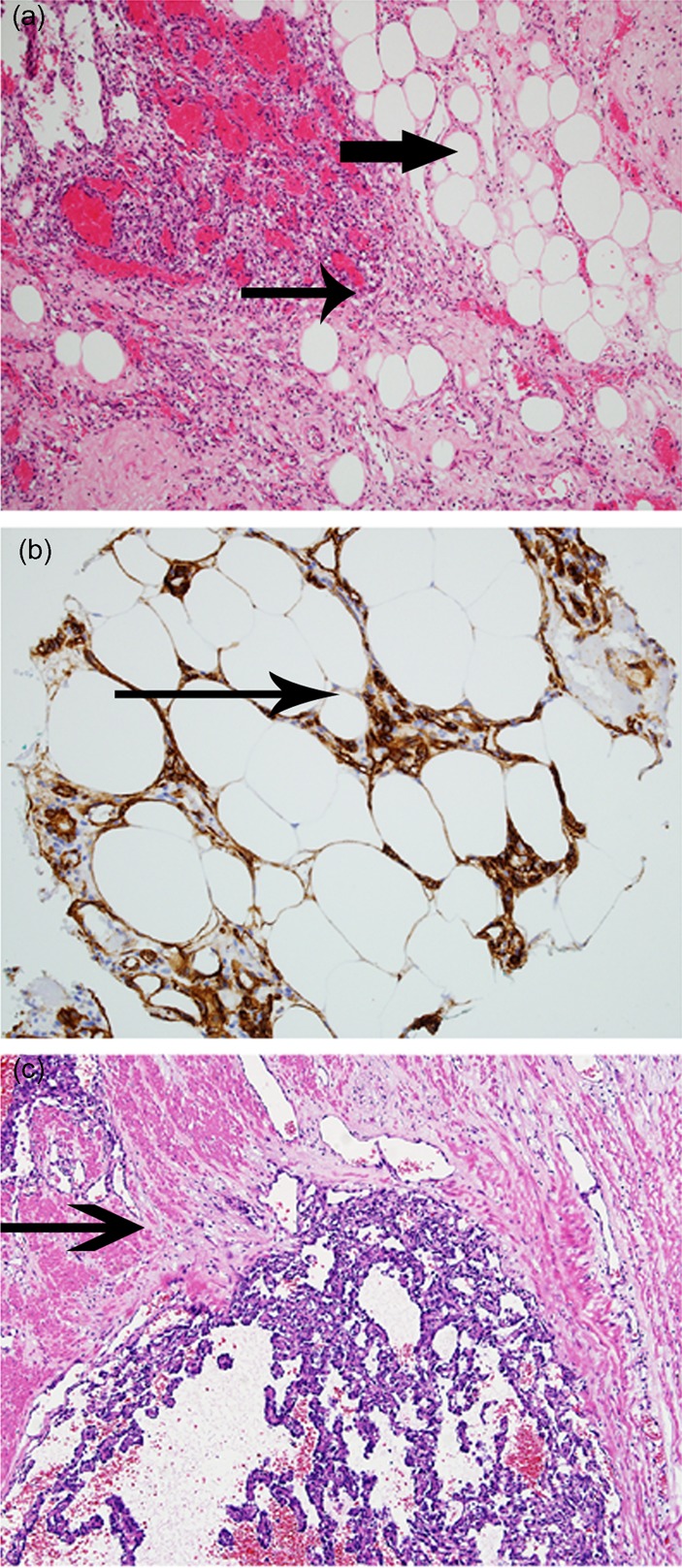 A rare cause of small bowel bleeding.