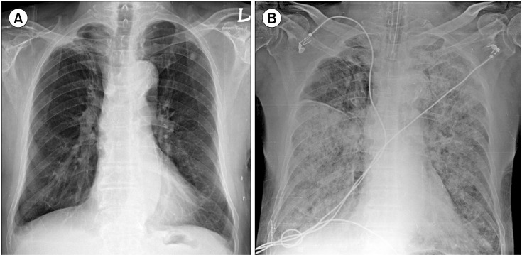 A case of transfusion-related acute lung injury induced by anti-human leukocyte antigen antibodies in acute leukemia.