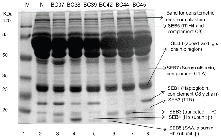 Potential biomarkers in the sera of breast cancer patients from bahawalpur, pakistan.