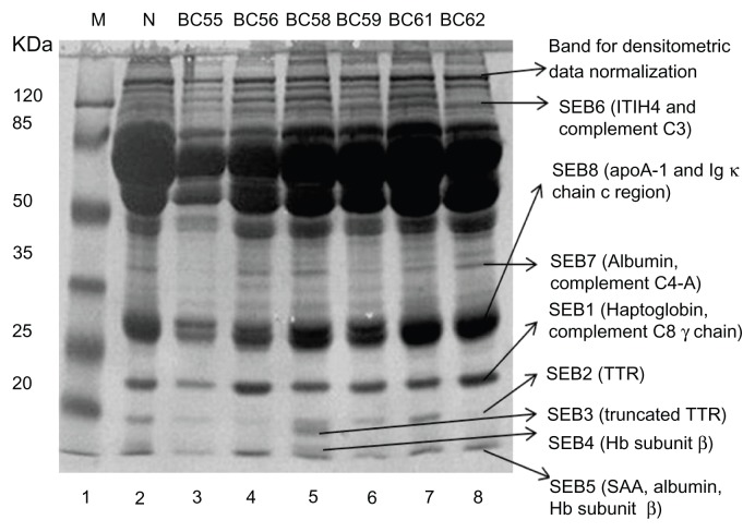 Potential biomarkers in the sera of breast cancer patients from bahawalpur, pakistan.