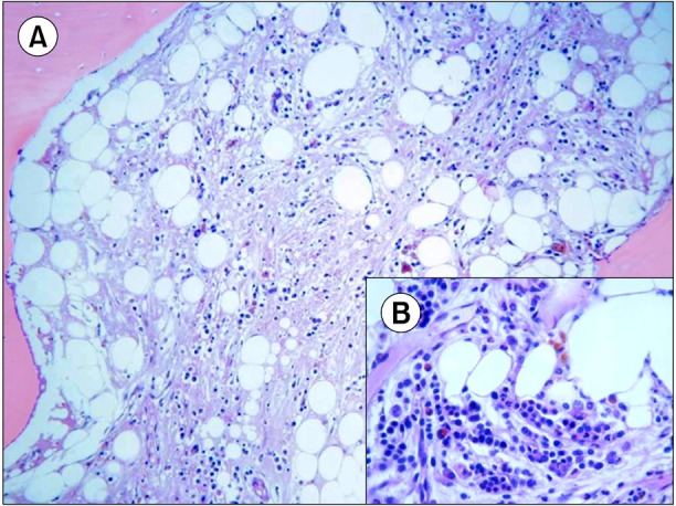 Long-term survival of a patient with bone marrow gelatinous degeneration of idiopathic origin.