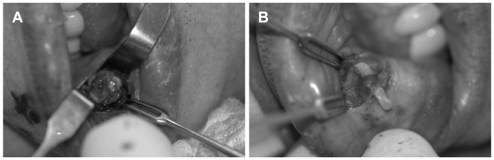 A case of pulsatile tinnitus from the atherosclerosis and atheroma in superior labial artery and facial artery.