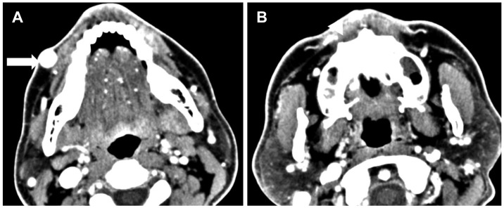 A case of pulsatile tinnitus from the atherosclerosis and atheroma in superior labial artery and facial artery.