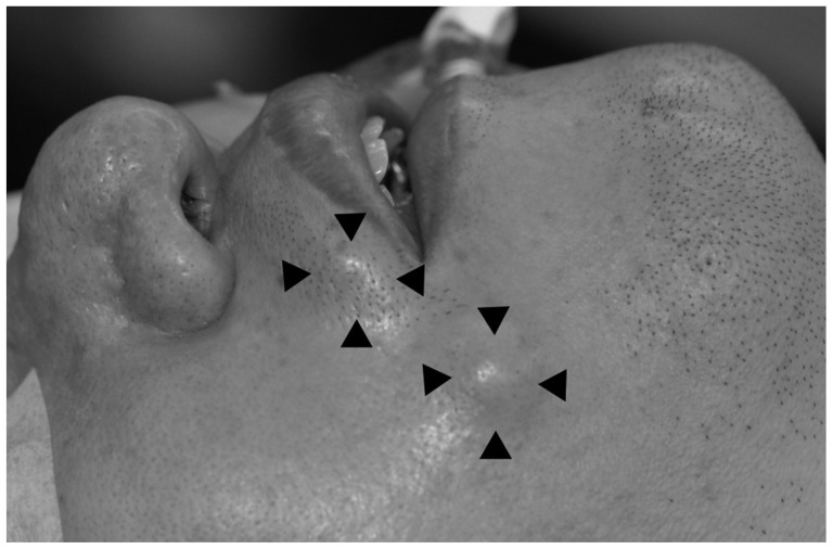 A case of pulsatile tinnitus from the atherosclerosis and atheroma in superior labial artery and facial artery.